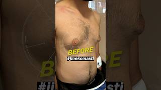 Gynecomasty Surgery BeforeAfter gynecomastiaresult [upl. by Chapell]