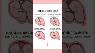 4 Types of twins medically Twin pregnancies pregnant youtubeshorts twins September 4 2024 [upl. by Conroy]