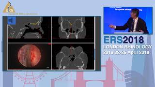 ERS London 2018 H Stammberger Advances In Fusion [upl. by Eelahc745]