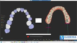 GuideMia OrthoPlus Automatic Treatment Planning Demo [upl. by Dayiz450]