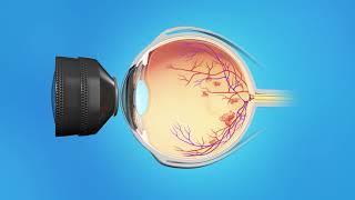 Central Retinal Vein Occlusion Treatment  Injection And Laser [upl. by Anelam199]