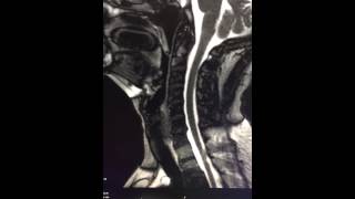 Dynamic MRI with Valsalva maneuver [upl. by Hgielek]