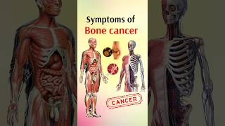 Symptoms of bone cancer shorts [upl. by Eidnac]