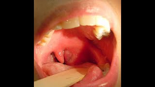 Peritonsillar Abscess [upl. by Ennasus964]