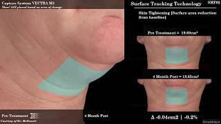 SculpSure for Submental Fat Reduction Under the Chin Fat [upl. by Ixela]