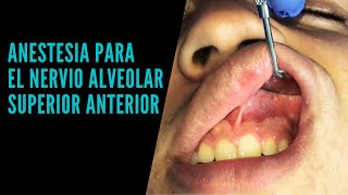 Anestesia para el nervio alveolar superior anterior  incisivo lateral [upl. by Danila]