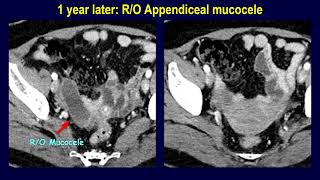 Appendiceal mucocele or mucinous neoplasm  Naming determines the management [upl. by Maxma]