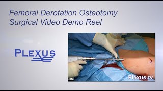 Bilateral Femoral Derotational Osteotomies Surgical Video [upl. by Linc]