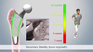 Mathys optimys – from primary to scondary stability including the recovery phases [upl. by Holms]