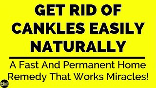 how to get rid of cankles [upl. by Ridglea831]