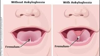 Tongue tie ANKYLOGLOSSIA in children enttongue tiedoctor ankyloglossiasurgeryday [upl. by Ines487]