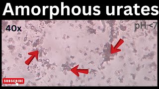 Amorphous urates in urine  medicallabtechnologysajal6903 [upl. by Roeser]