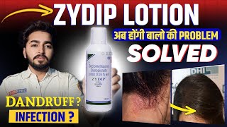 Zydip Lotion Review  Zydip Lotion For Hair [upl. by Savell]