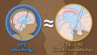 Treatment for Postinfectious Hydrocephalus in Infants [upl. by Salomi]