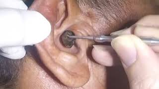 Removing MASSIVE Earwax from Mans Ear [upl. by Afinom492]