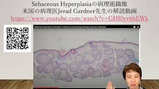 Sebaceous Hyperplasiaの病理組織像 [upl. by Emmy]