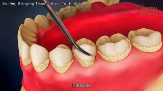 Teeth scaling to remove plaque  3d animated video  Dental Solutions Clinic Bangalore [upl. by Norok]