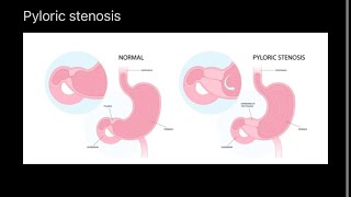 Pyloric stenosis nursing [upl. by Aleen]