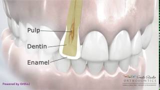 Interproximal Reduction Showing Cross Section  Orthodontic Treatment [upl. by Phyllida]