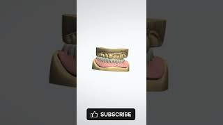 Lower Partial Denture partialdenture dentalprosthesis [upl. by Anertal]