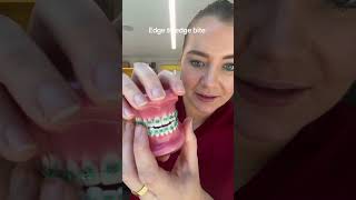 Overbite vs overjet overbite overjet braces [upl. by Elsa]