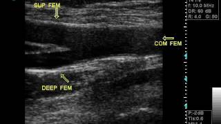 DOPPLER VASCULAR ULTRASOUND OPTIMAL VIEW OF COMMON ARTERYS BIFwmv [upl. by Neelhtakyram352]