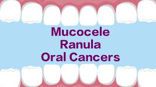 Mucocele  Ranula  Oral Cancers [upl. by Duwad774]