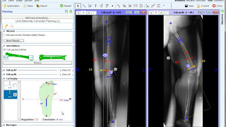 Lateral LAT Lower Limb Deformity Correction Planning  Materialise OrthoView [upl. by Nadoj]