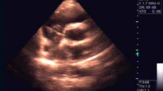 Echocardiography of Hydatide cyst in the interatrial septum [upl. by Alimak]