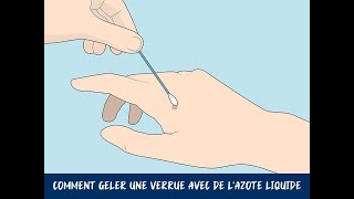 Comment geler une verrue avec de lazote liquide [upl. by Evars]