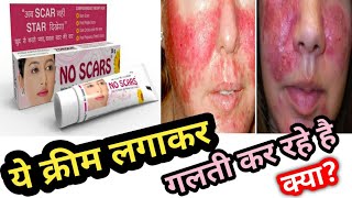 No Scar Cream Honest Review 2021 In Hindi Side Effects Uses  Price  My opinion  पूरी सच्चाई [upl. by Egin]