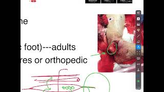 Osteomyelitis [upl. by Liss]