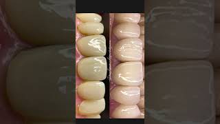 Zircon crowns VS Ceramic veneers zirconcrowns ceramicveneers ainurtassilova almaty [upl. by Adieno251]