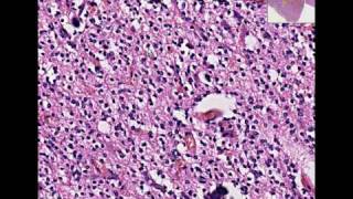 Histopathology BrainOligodendroglioma [upl. by Egiedan]