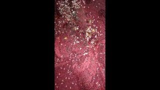 Worst Bed Bug infestation in AkronOhio [upl. by Anigroeg554]