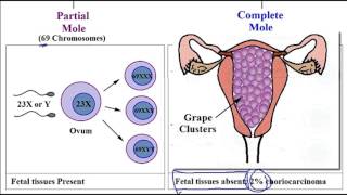 Video 254 Hydatidiform Mole Molar Pregnancy Partial vs Complete Mole amp Associated Risk Factors [upl. by Anaej]