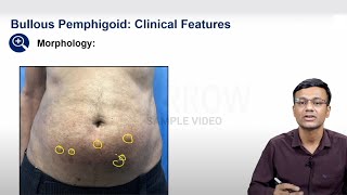 E6 Sample Video Pemphigoid Group of Bullous Disorders Dermatology [upl. by Euridice]