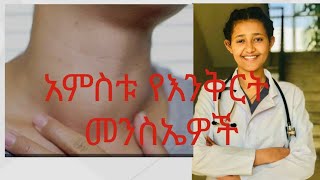 እንቅርትGoiter እንቅርት goiter habesha Ethiopia doctor medicaleducation [upl. by Mcnair]