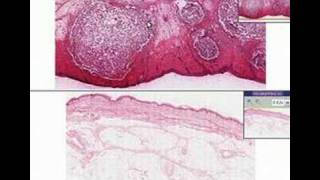 Histopathology Skin Furuncle abscess [upl. by Derron]