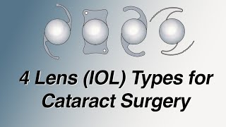 4 Main Lens IOL Types for Cataract Surgery Pros and Cons Basic Version [upl. by Volding137]