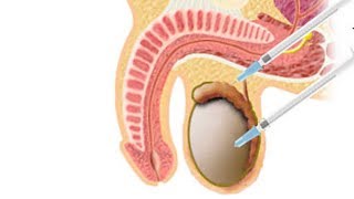 Techniques for Surgical Sperm RetrievalDr Sathya Balasubramanyam of Cloudnine Hospitals [upl. by Arrekahs]