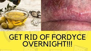 How To Get Rid Of Fordyce Spots On Lips And Shaft Overnight Naturally Fast At Home [upl. by Svetlana]