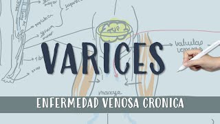 VARICES  Flebitis varices  ENFERMEDAD VENOSA CRONICA [upl. by Ytisahcal]