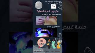 Omani Womens Day offers only for 160 OR بوتوكس مع تبييض الاسنان فقط ب 160 ريال ليوم المرأة العمانية [upl. by Ahsenit716]