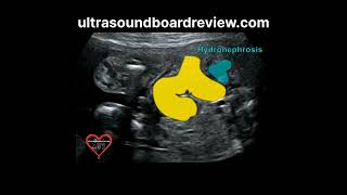 Hydronephrosis Fetal Ultrasound [upl. by Quartana]