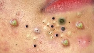 Blackheads amp Acne Treatment Latest Update 97 [upl. by Ykcir]