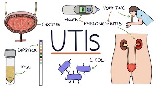 Understanding Urinary Tract Infections [upl. by Atteyram340]