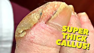 THICK Cracked Callus Trimming Satisfying [upl. by Eiramalegna]