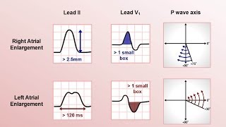 Intro to EKG Interpretation  Chamber Enlargement [upl. by Arikahs]