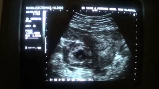 complicated RT adnexal CYSTIC MASS with FLUID [upl. by Othilie452]